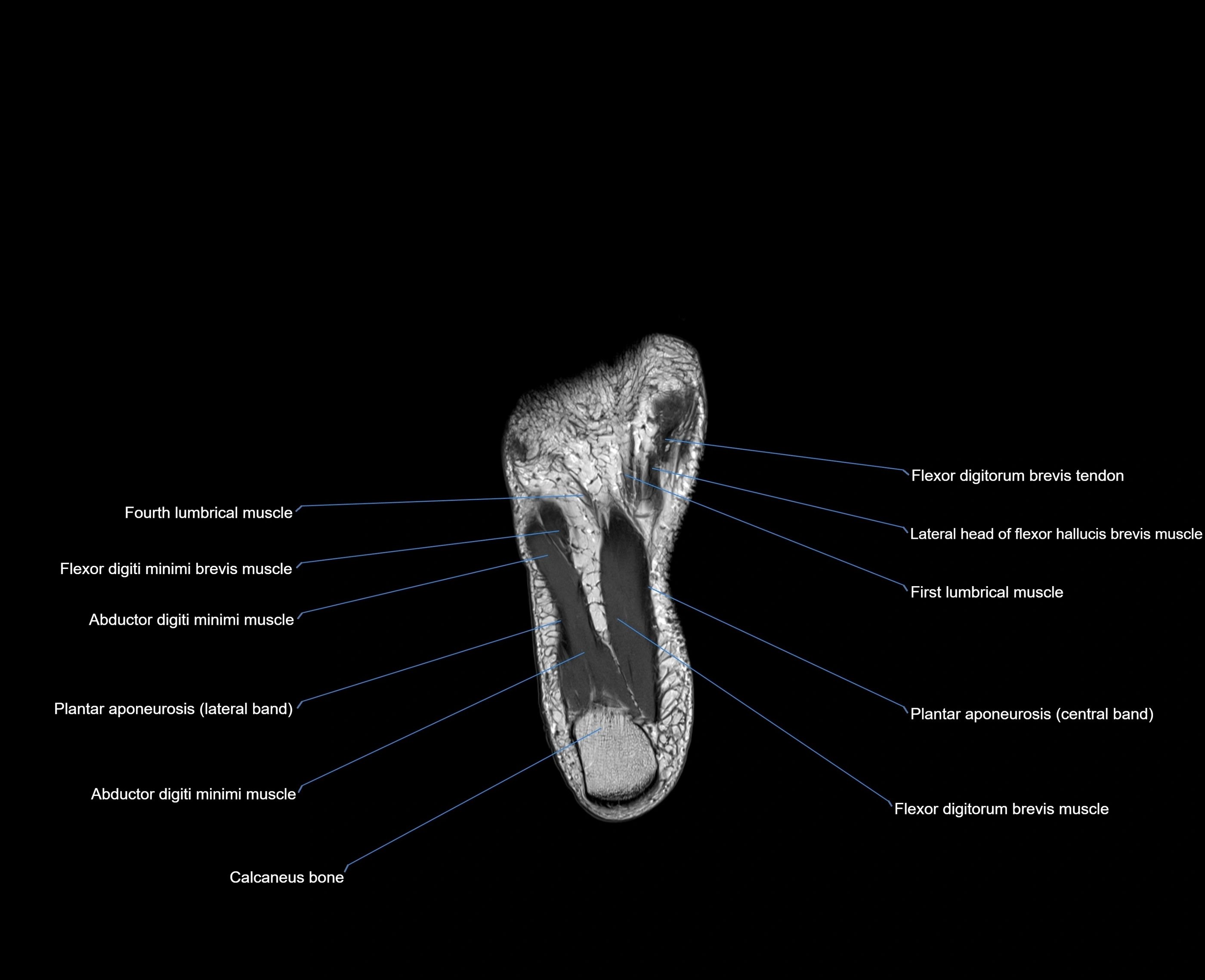 MRI foot coronal cross sectional anatomy 3T  radiology  image-img-00001-00029.webp